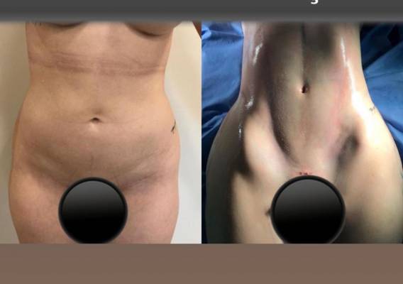 Antes e depois da cirurgia lipo lad