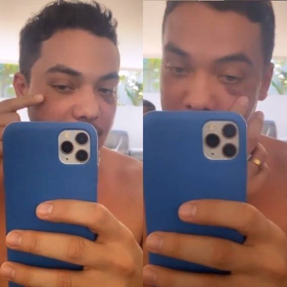 Após procedimento para retirar olheiras, Wesley Safadão aparece com olho roxo (Reprodução/Instagram)