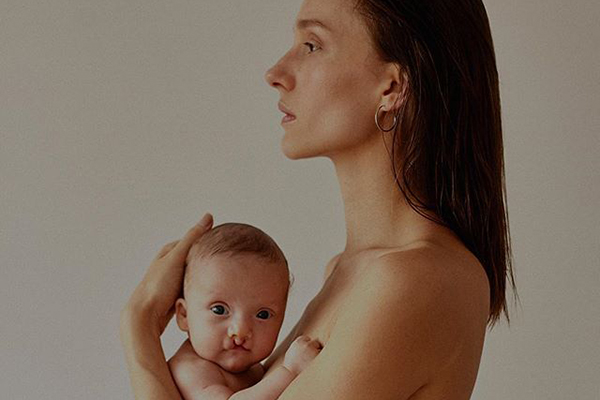Isabel Hickmann revela que filho nasceu com lábio leporino
