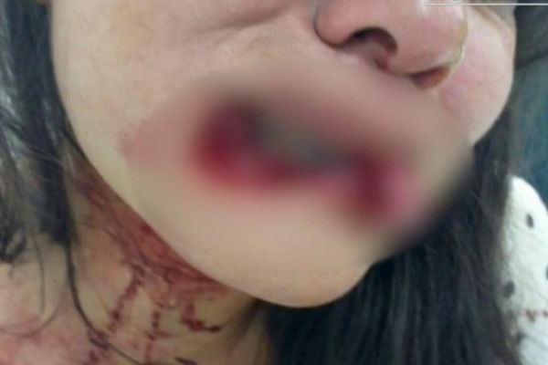 Famosa tem ataque de fúria e arranca lábio de inimiga em balada