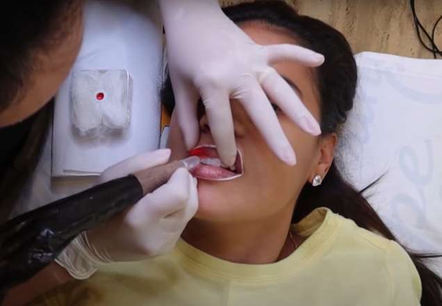 Simone, da dupla com Simaria, faz micropigmentação na boca e sobrancelhas