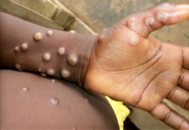 Contato sexual pode ter aumentado transmissão da varíola dos macacos | Reprodução/AP