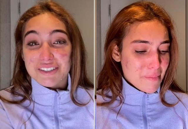 Montagem com fotos de Vanessa Lopes chorando ao desabafar sobre problema com acnes espinhas