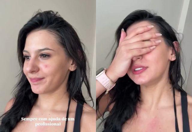 Ana Castela mostra rosto com acne e inicia tratamento forte: Sofrendo!