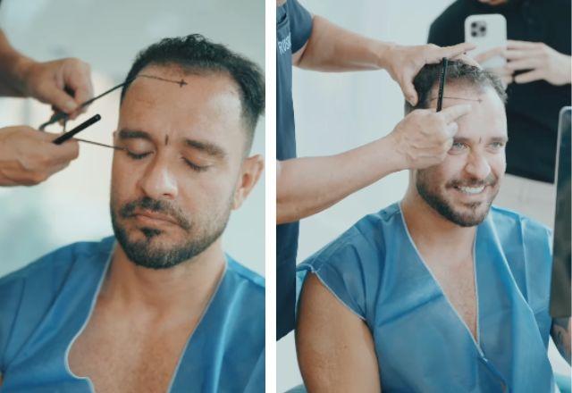 Diogo Nogueira em procedimento de transplante capilar.