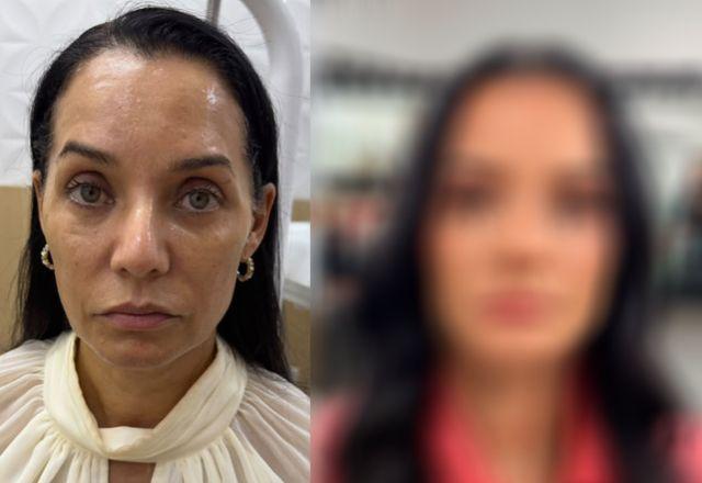 Imagem da notícia: Mônica Carvalho passa por harmonização facial; confira o resultado Imagem da notícia: Mônica Carvalho passa por harmonização facial; confira o resultado