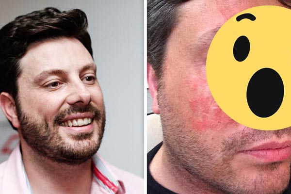 Danilo Gentili queima o rosto e fãs se assustam com imagem