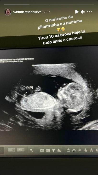 Ultrassom do filho de Whindersson Nunes (Reprodução/Instagram)