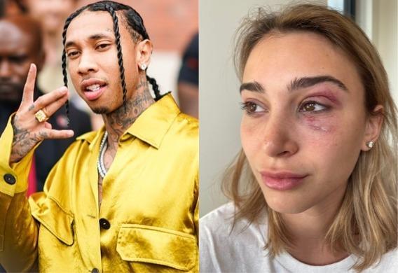 Rapper Tyga à esquerda; Camaryn Swanson com o olho roxo à direita