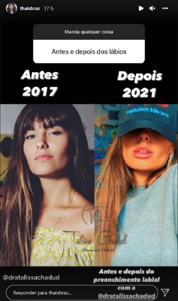 Thais Braz mostra antes e depois dos lábios