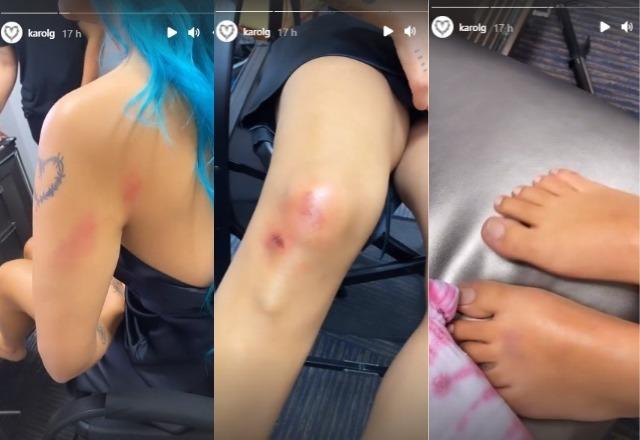 Karol G mostra hematomas nos braços, pernas e pés após queda em show