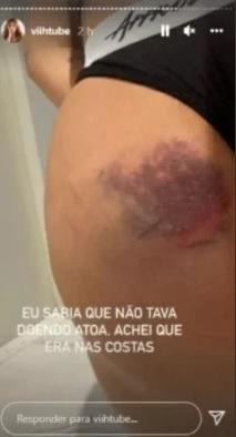 Viih Tube mostrando hematoma nos stories do Instagram.