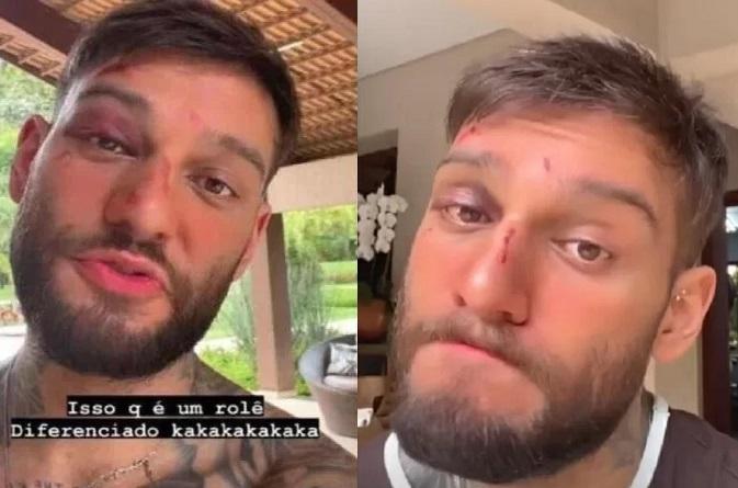 Lucas Lucco mostra o rosto machucado nos stories do Instagram. 