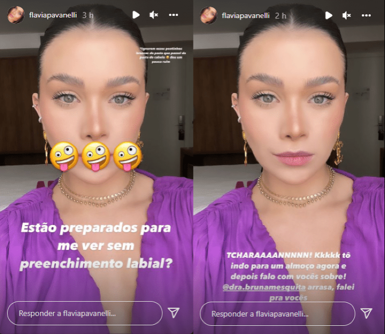 Flavia Pavanelli mostrando remoção de preenchimento labial nos stories do Instagram.