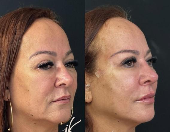 Imagens de Nadine Gonçalves de lado antes e depois da harmonização facial