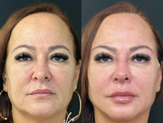 Imagens de Nadine Gonçalves de frente antes e depois da harmonização facial