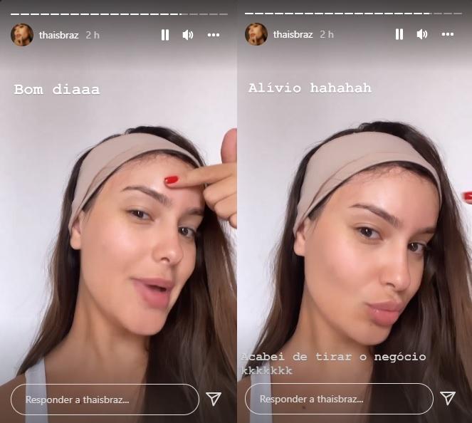 Thais Braz mostrando o resultado do procedimento através dos stories do Instagram