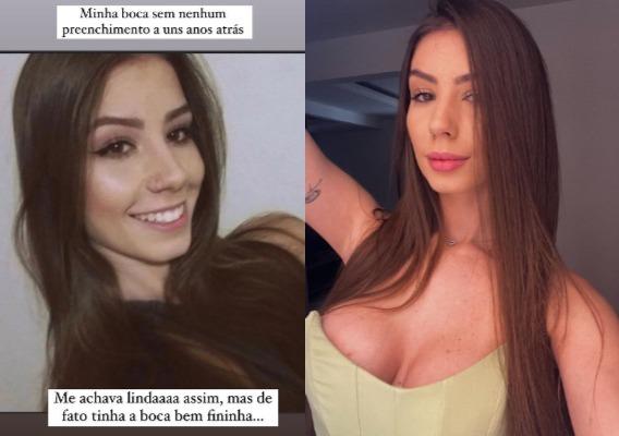 Fotos de Maria Lina antes e depois de preenchimento labial