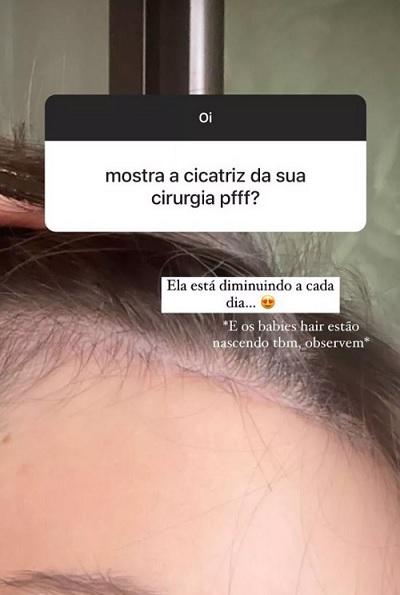 Printo do storie de Thais Braz mostrando resultado da cirurgia