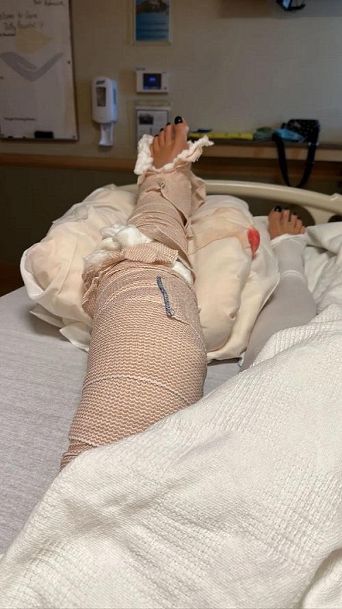Print dos stories de Luciana Gimenez mostrando a perna enfaixada. 