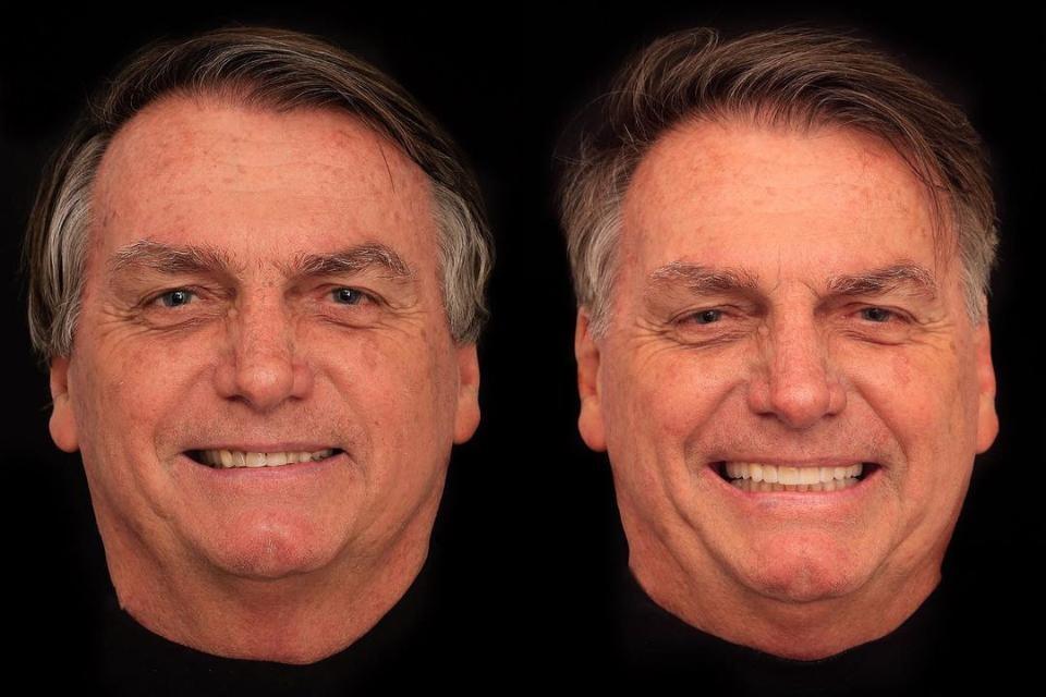 Bolsonaro faz harmoniza\u00e7\u00e3o facial e renova sorris\u00e3o; veja resultado ...