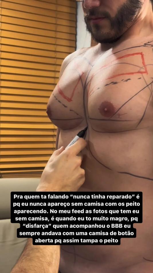 Eliezer mostra marcações para cirurgia.