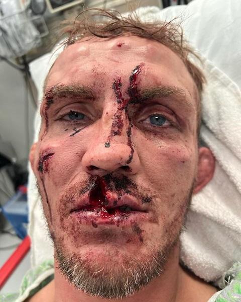 Rosto desfigurado de Jason Knight