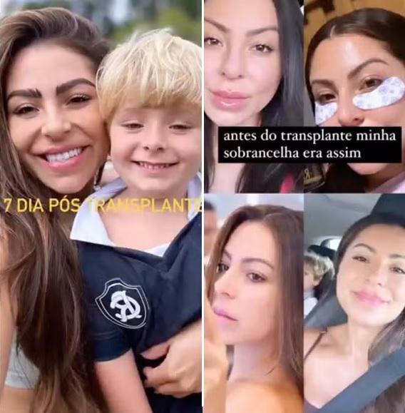 Andressa Miranda mostra resultado de transplante de sobrancelha