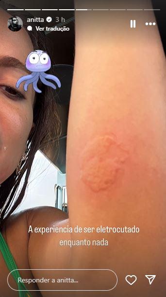 Anitta mostra cicatriz de queimadura no braço.