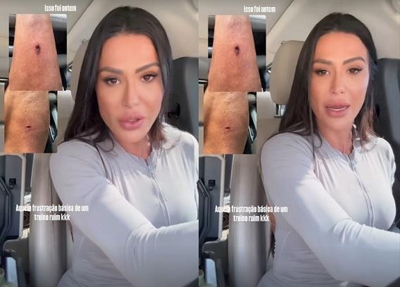 Gracyanne Barbosa mostra machucado