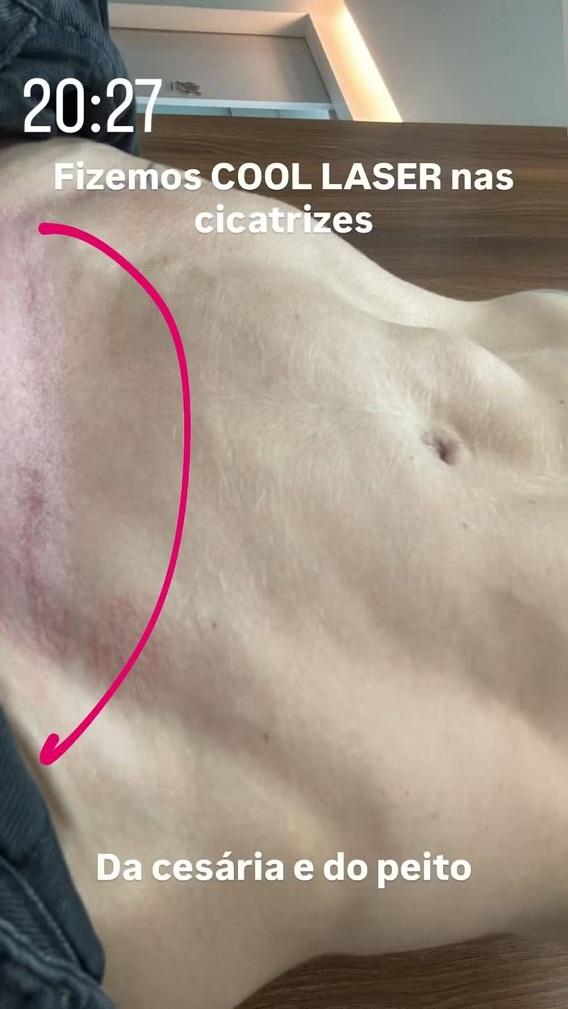 Tratamento de Virginia para suavizar cicatriz da cesariana