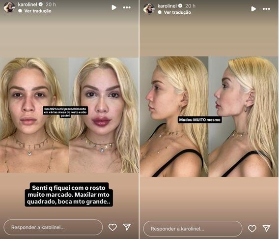 Antes e depois Karoline Lima