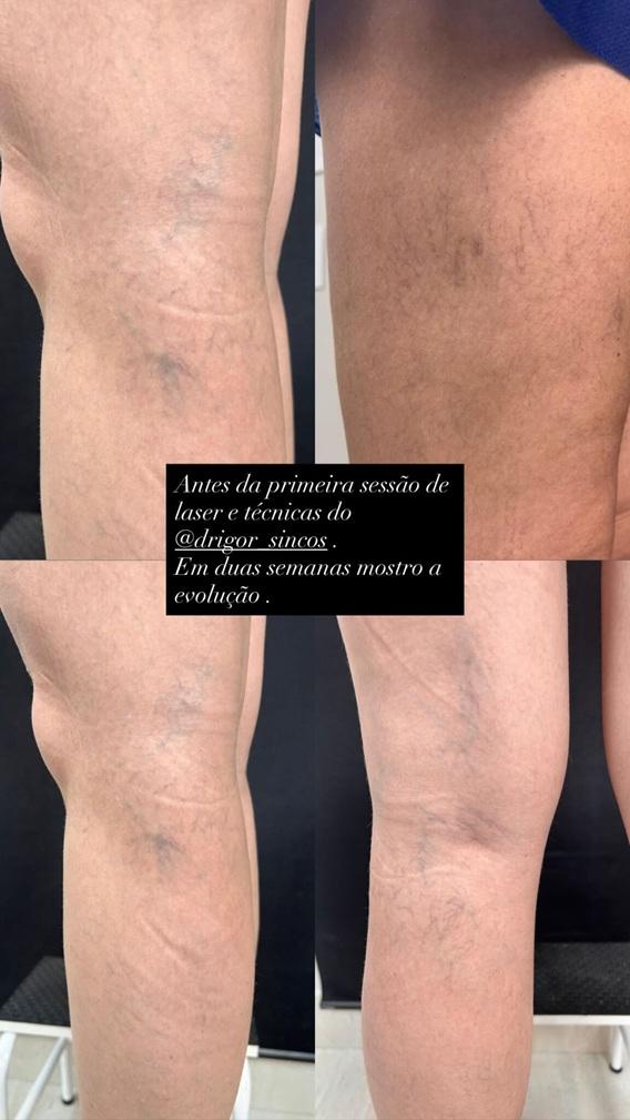 Ana Hickmann mostra varizes nas pernas