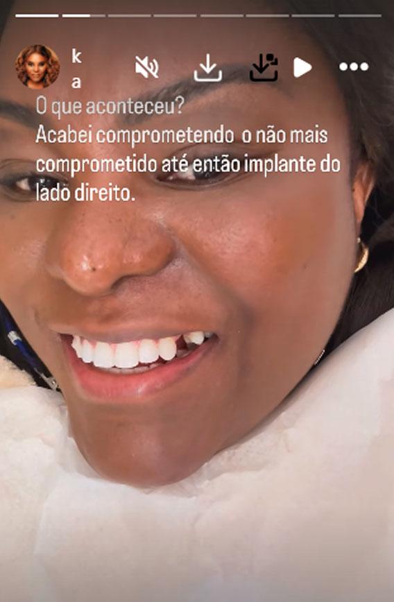 print dos stories de karin hils onde ela aparece sem dente