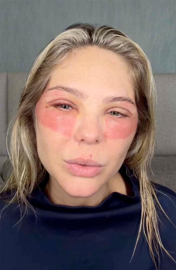 Thais Gebelein mostrando rosto após cirurgia nos olhos